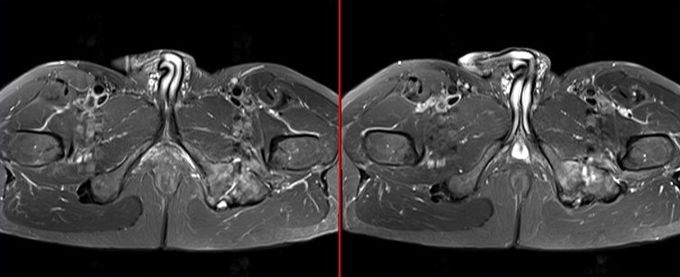 Figure 2 for case Ischiofemoral impingement